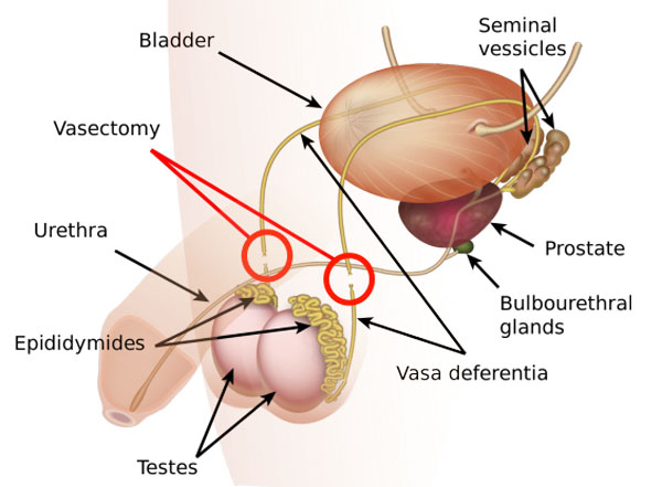 Vasectomy Surgery Melbourne