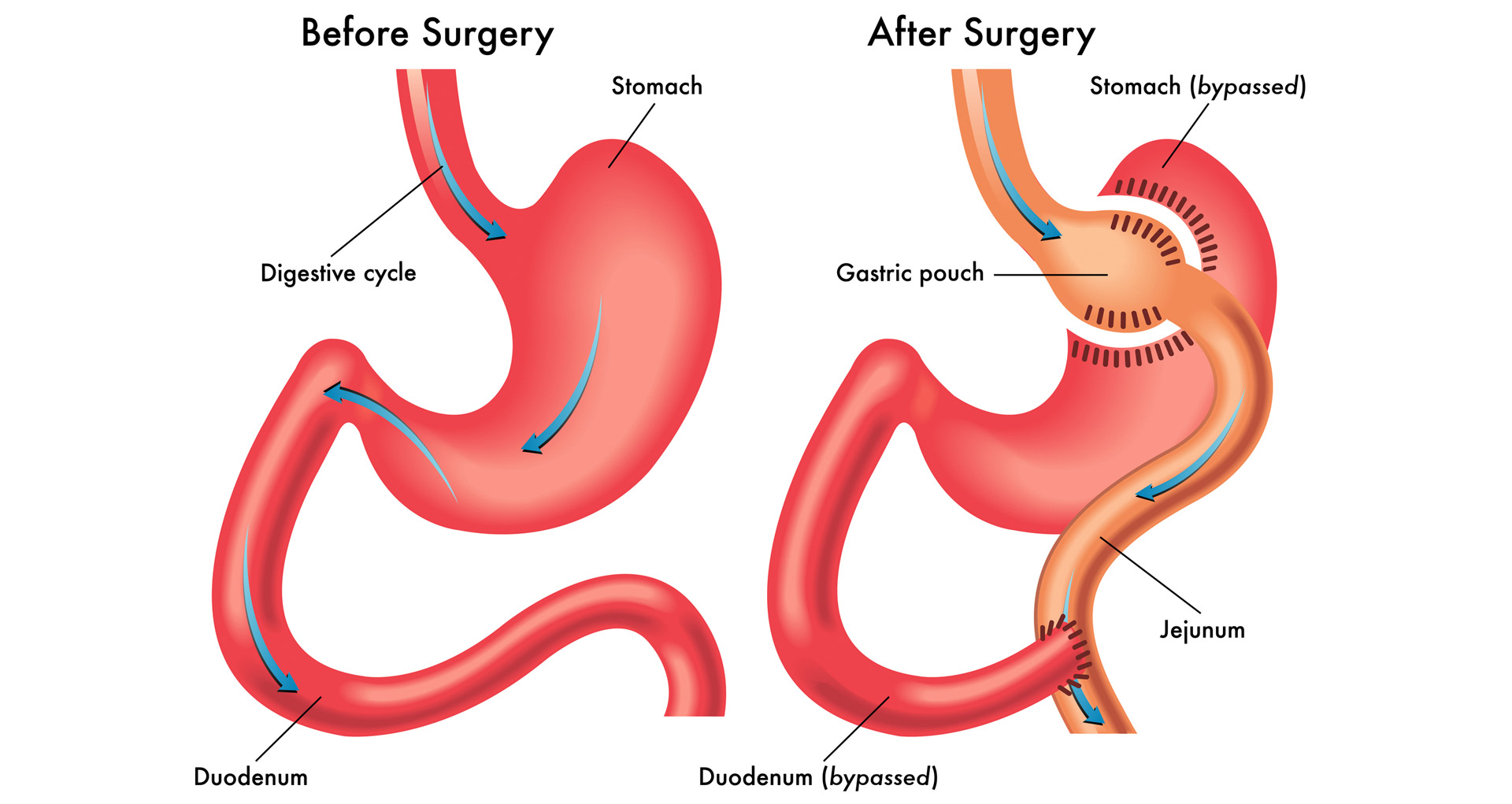 What Is The Mini Gastric Bypass Winnett Specialist Group 