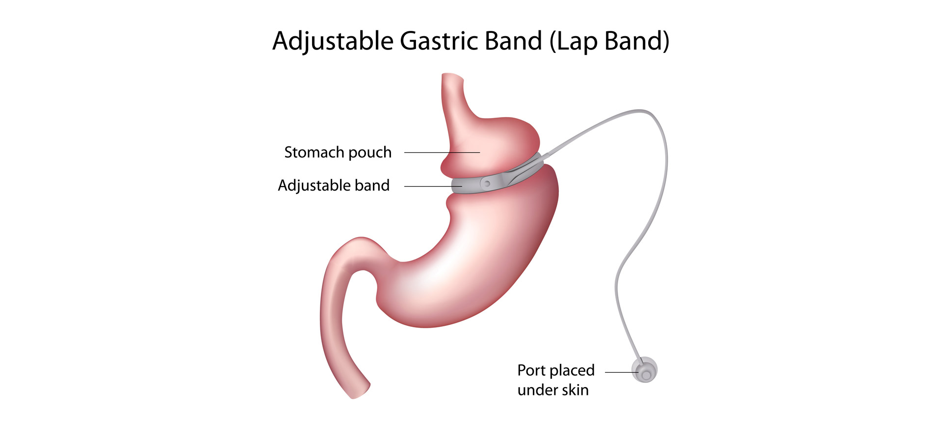 Gastric Band Weight Loss Surgery.Band with a Port that Under the Skin Stock  Vector - Illustration of anatomy, vector: 182786723