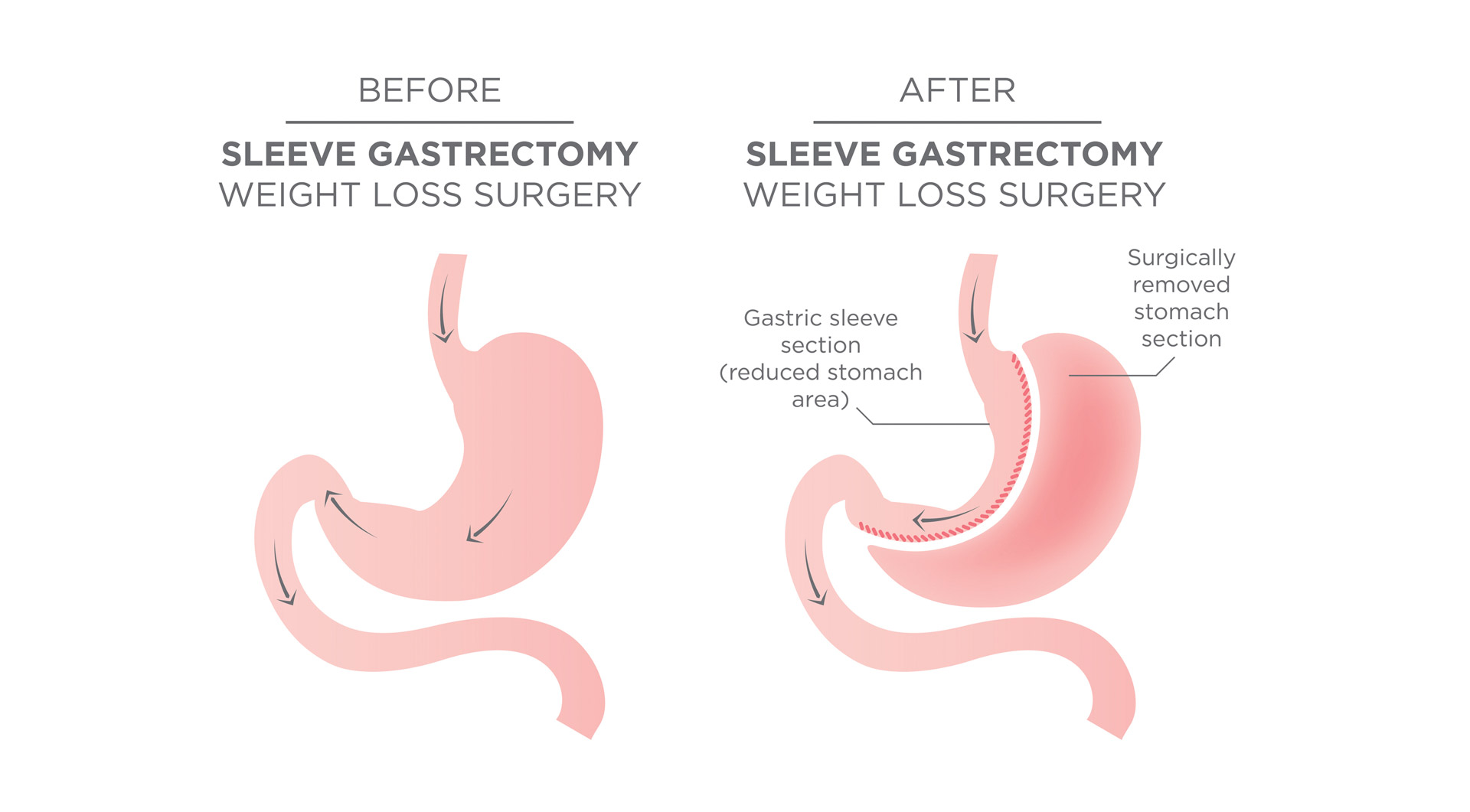 What is a Sleeve Gastrectomy? Specialist Group