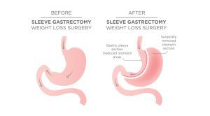 Sleeve-Gastrectomy-Melbourne (1)